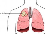 CRNA GORA: Najviše oboljelih od karcinom pluća i dojke