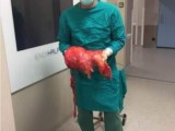 SARAJEVO: Na KCUS pacijentkinji odstranjen tumor od 11,4 kg